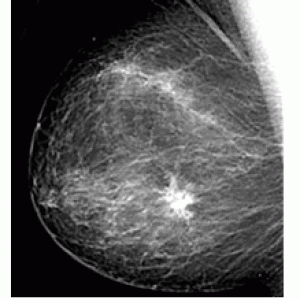 mammografia-digitale